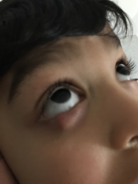 Chalazion 4 year old