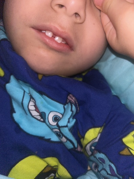 White spots on toddler teeth
