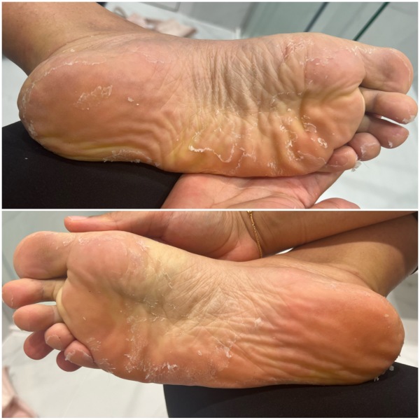 What’s going on with my feet?! (Photo included) *Trigger* looks grim