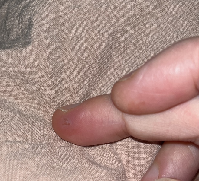 Please help - incredibly painful finger, weird thing on it!!