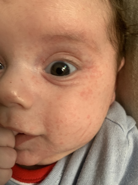 CMPA rash or acne/dermatitis?