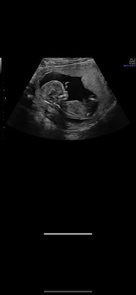 Placenta - anterior or posterior?