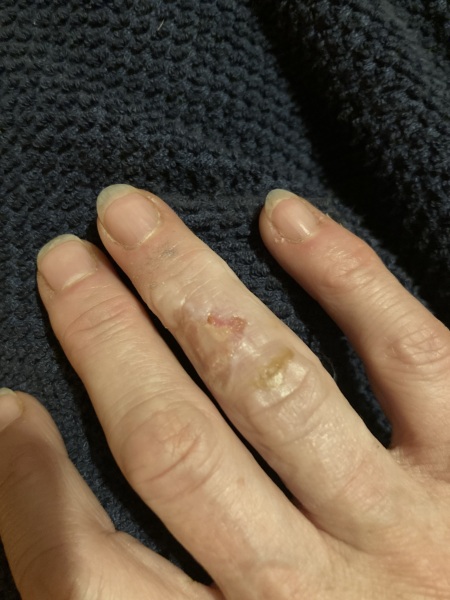 What am I supposed to do with this? Burnt finger; pic included