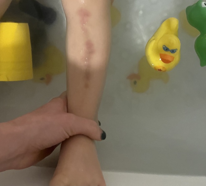 Toddler leg bruises