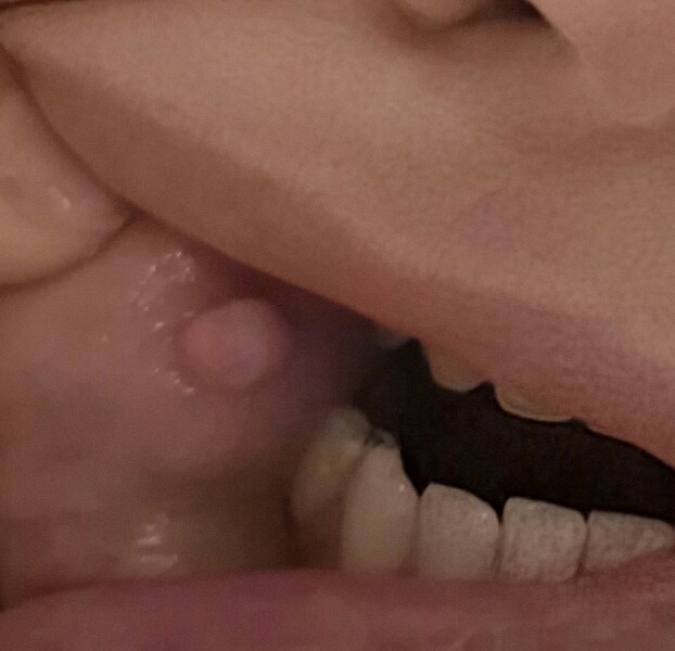 Any dentists around? (slightly gross pic attached)