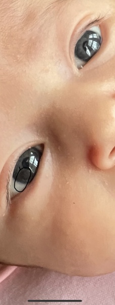 Brown band in my newborn eyes (picture included )
