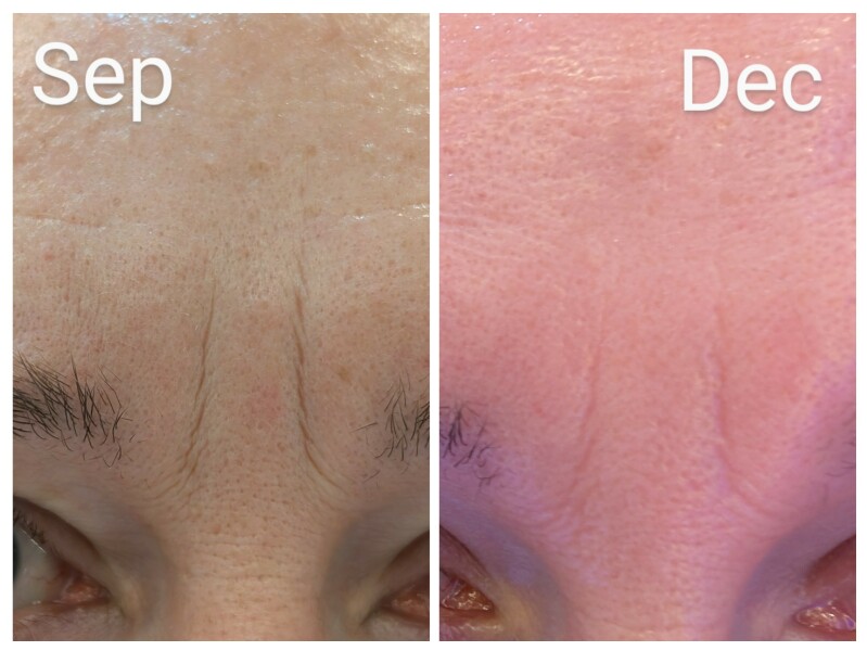 Tretinoin 0.006 - I think I can see an improvement already!! (Pic)