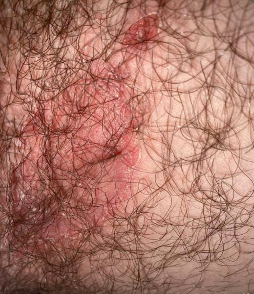 Rash on my son's inner thigh.