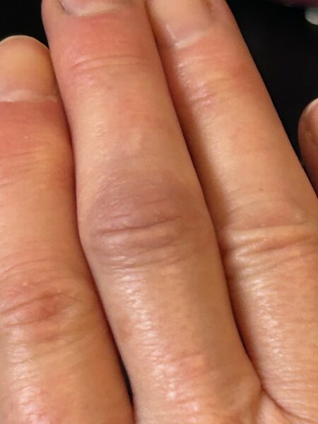 A thread for those with psoriatic arthritis?