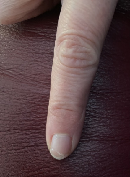 Proven treatments for natural peeling nails