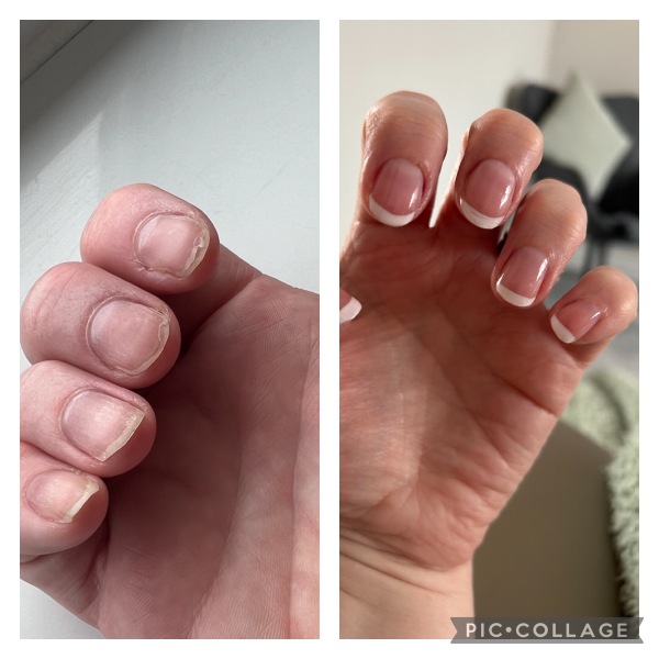Proven treatments for natural peeling nails