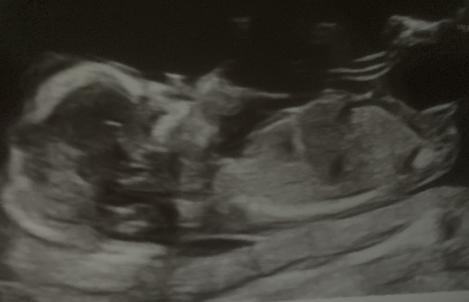 Nub theory guesses 14 weeks?