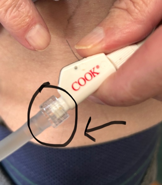 Posting for traffic - nephrostomy connector help needed!