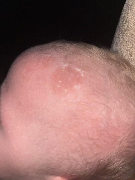 What is this on my sons head???