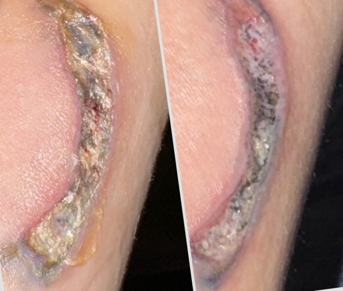 Warning gross photo! Should I go back to urgent care?