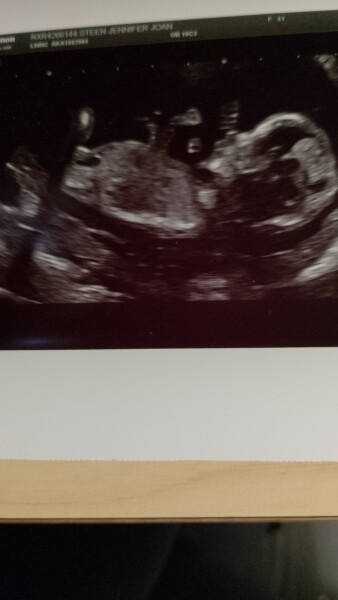 Nub theory 13:5 week scan