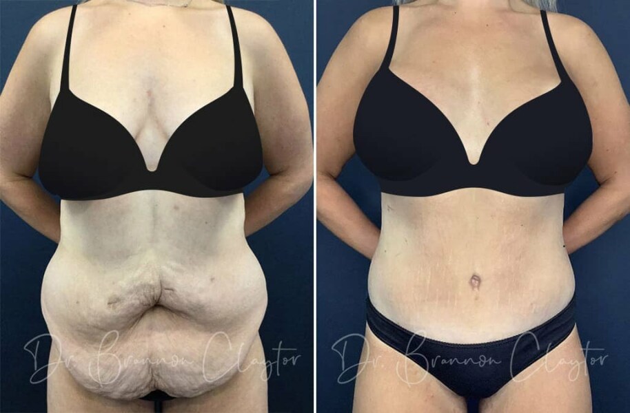 How do I get rid of belly fat?
