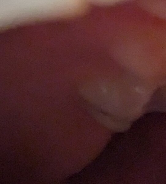 Daughters molar has a black crack going through it (rubbish pick attached)