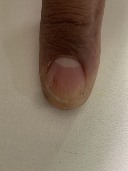 Black line on my nail!