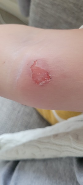 Anyone sustained any injuries over the festive season*?