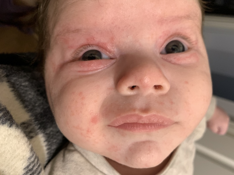 Baby acne/eczema or CMPA rash? Help pls.