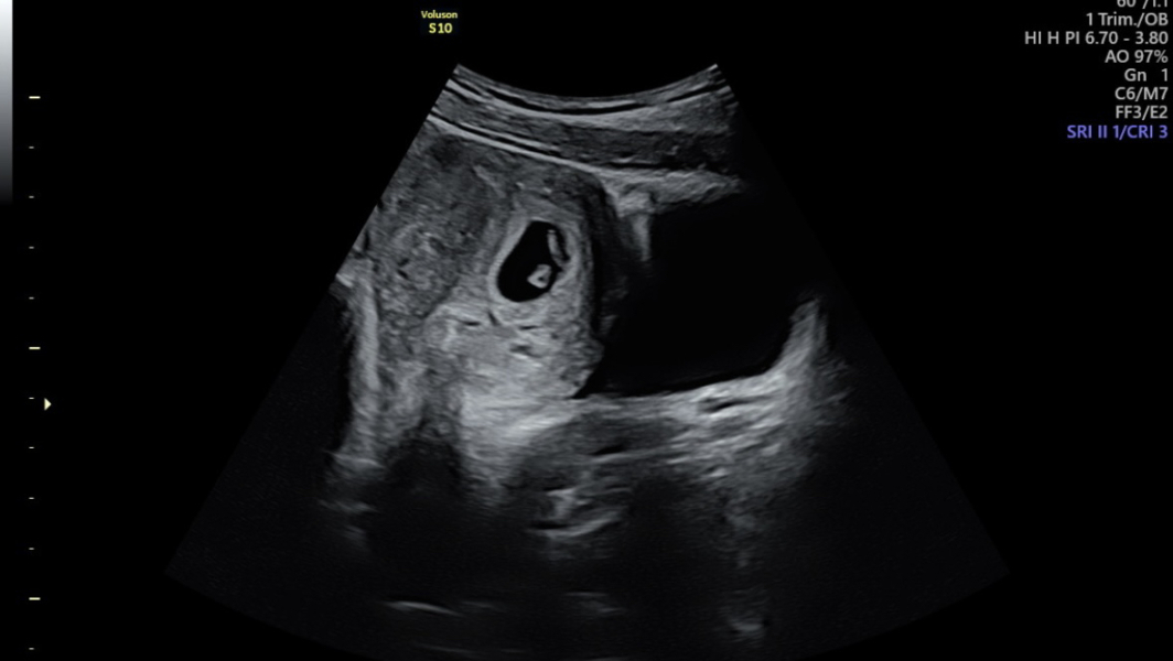 11DPO positive - but concerned