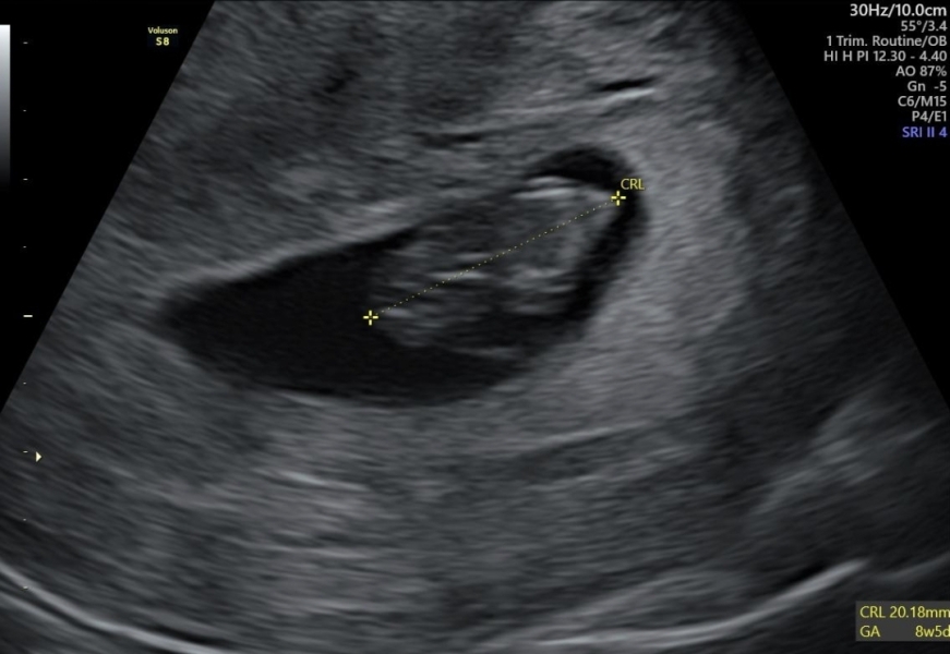 Due July 25 - Thread 2 - Approaching the 12 week scans!