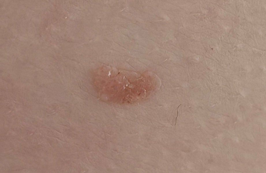Is this mole anything to worry about?!