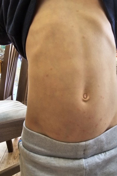 Is this chickenpox? Pic attached