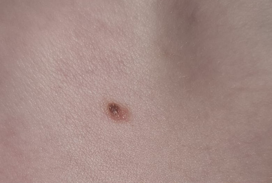 Does this mole look suspicious?