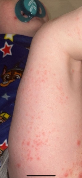 Anyone seen a rash like this before??