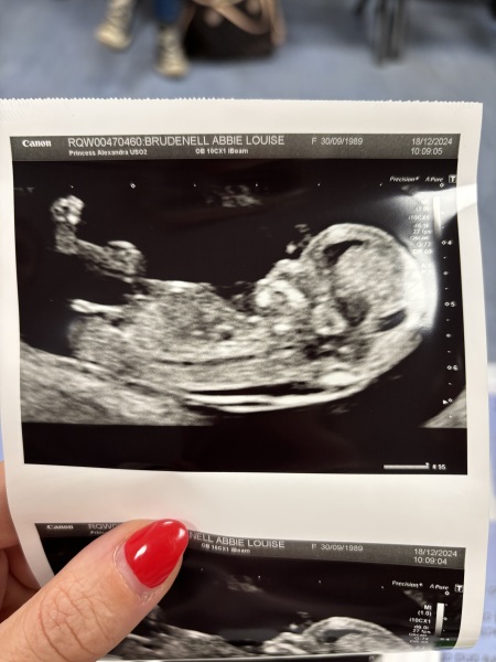 Due July 25 - Thread 2 - Approaching the 12 week scans!