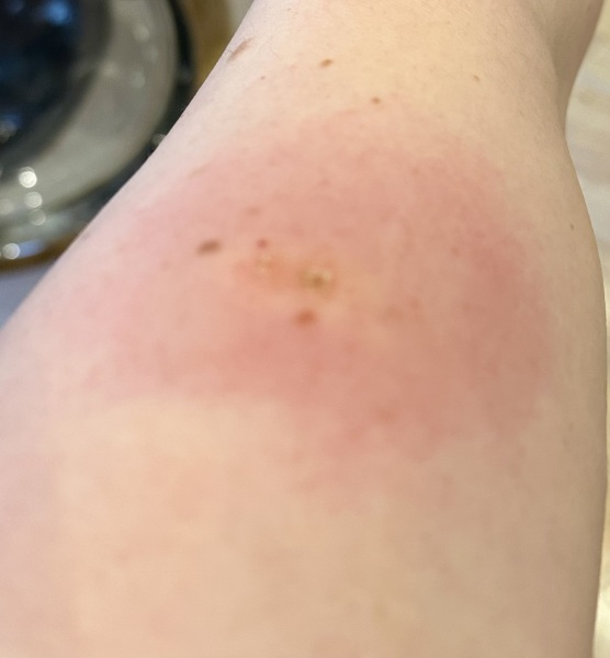 Can anyone help with this bite/lump?