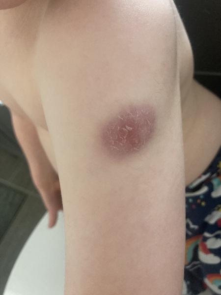 BCG scar popped 2nd time on my 4 month old's arm