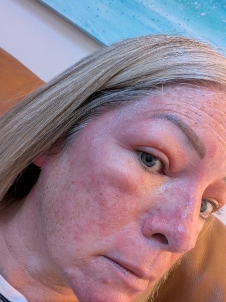 Possible cellulitis round eye, can't tell if it looks worse. Pics for opinions please!