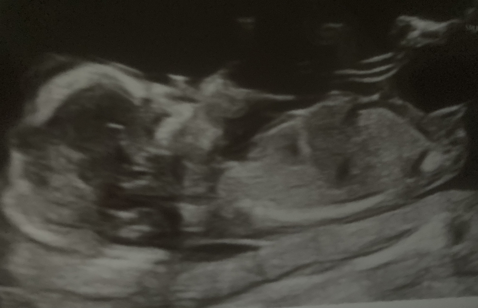 Due July 25 - Thread 2 - Approaching the 12 week scans!
