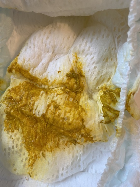 EBF 5-week-old - is this poo normal? (TMI picture, sorry!)