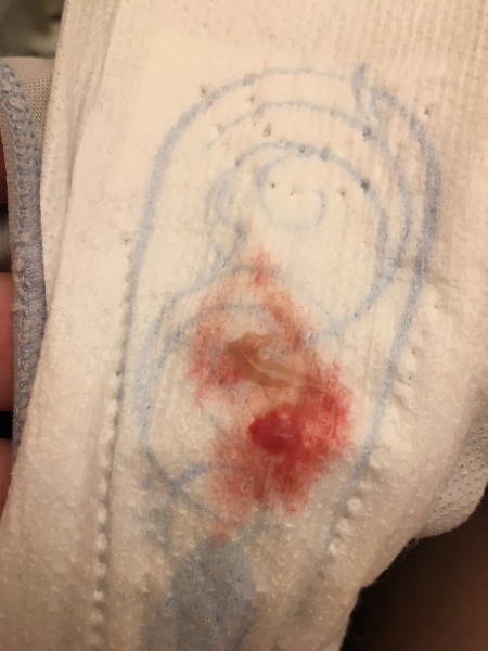 Is this implantation bleeding?