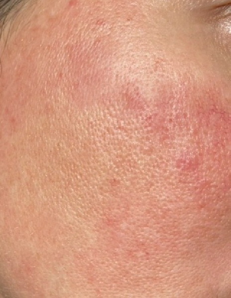 I ve rosacea, i'm afraid my daughter will too