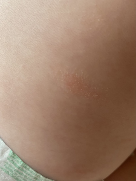 Dry skin