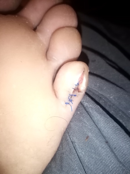 Melanoma on little toe? Picture attached.