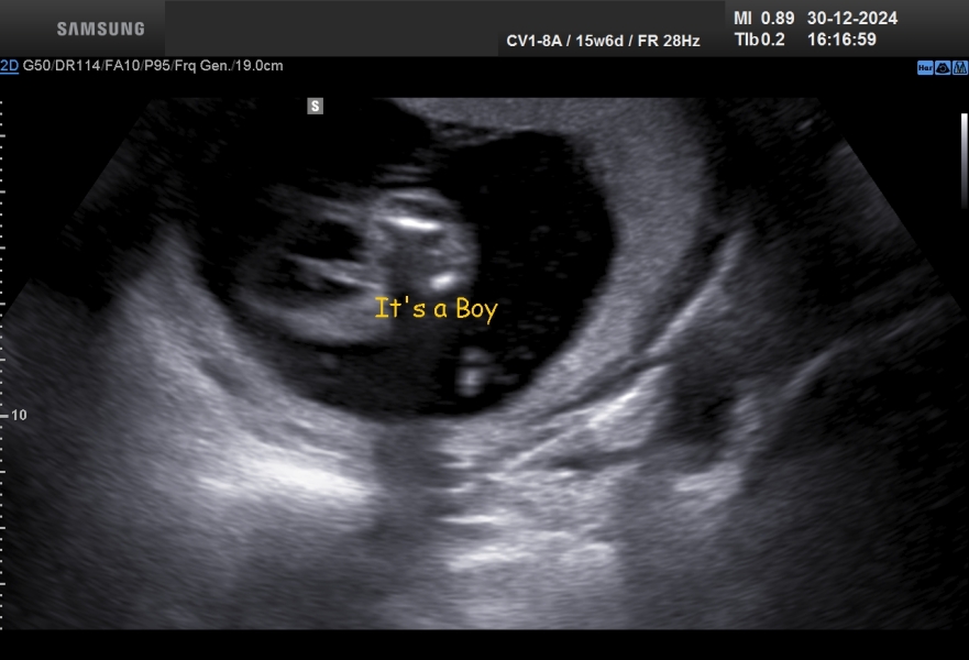 Gender scans