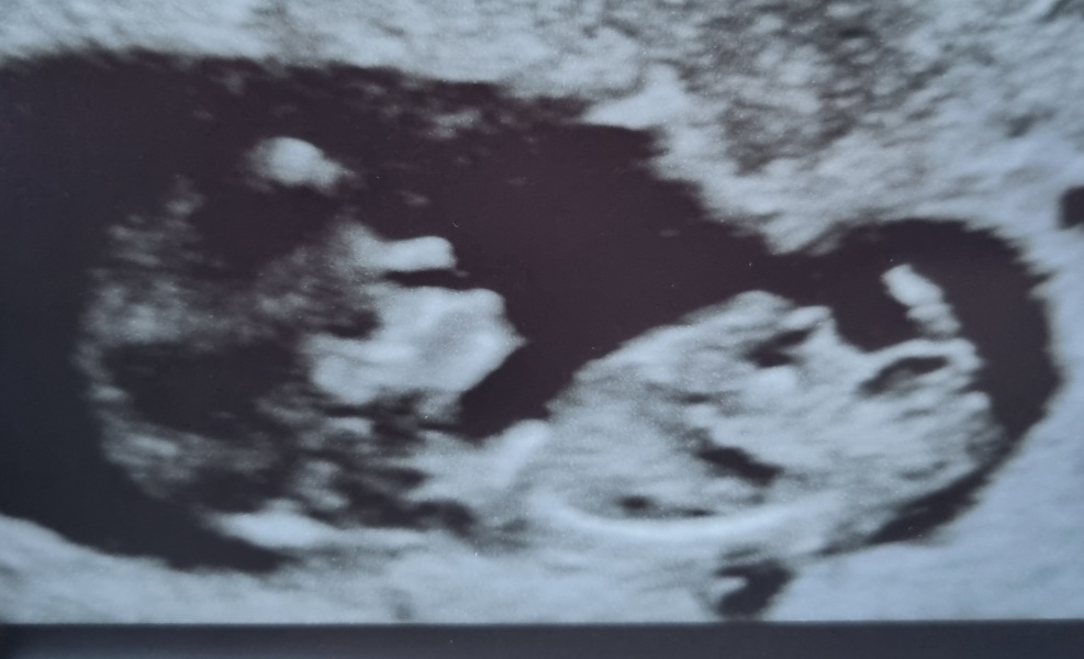 Due July 25 - Thread 2 - Approaching the 12 week scans!