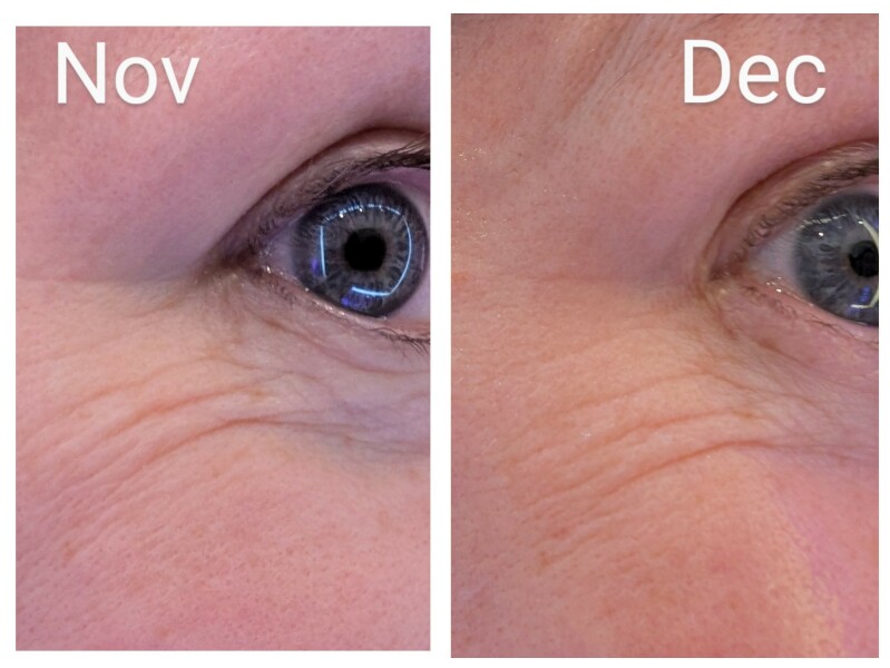 Tretinoin 0.006 - I think I can see an improvement already!! (Pic)