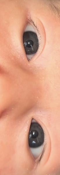 Brown band in my newborn eyes (picture included )