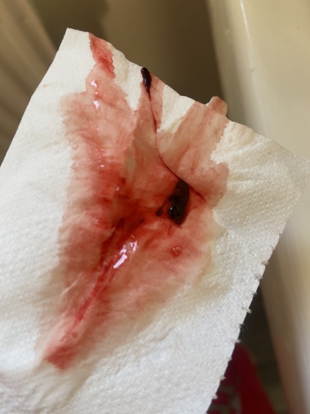 TW- 5ish weeks and bleeding with small clots