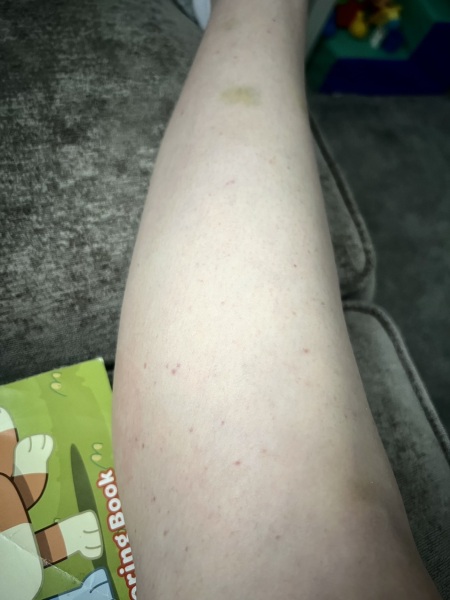 Petechiae on legs