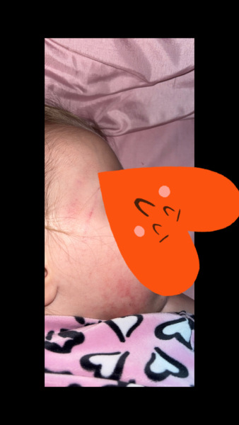 Bruising/Marks from childcare