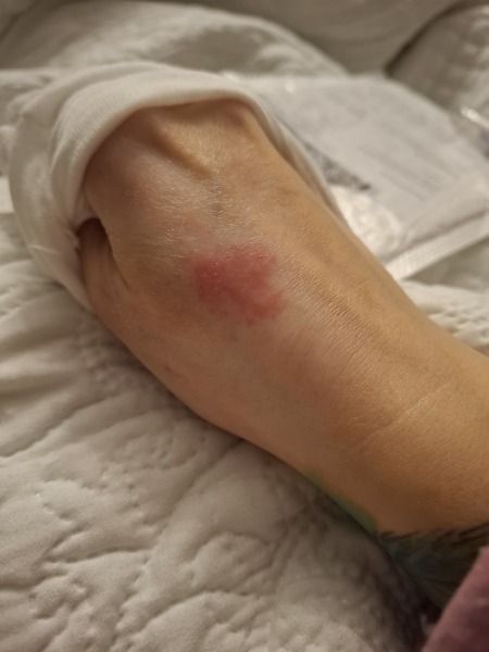Hand infected (Warning, gross photos)