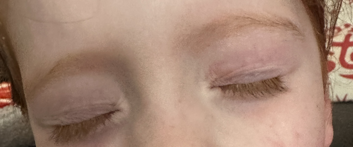 Swollen eye 3 year old
